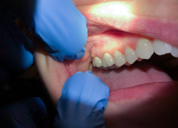 Best Emergency Treatment for Toothache in Edgefield, SC
